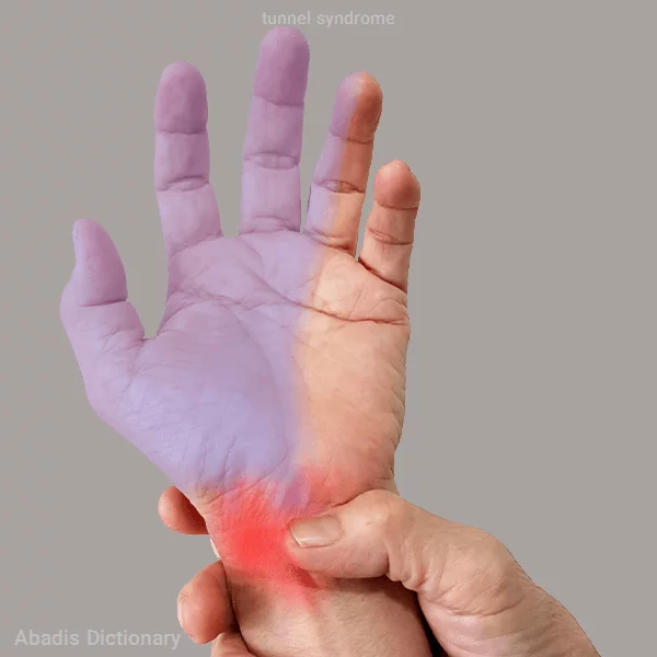tunnel syndrome